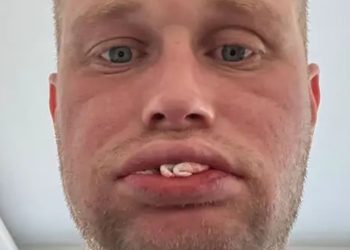 Homem perde todos os dentes após passar por tratamento na Turquia