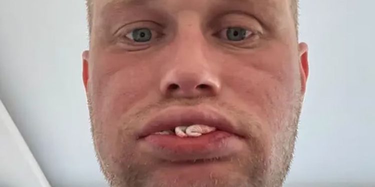 Homem perde todos os dentes após passar por tratamento na Turquia