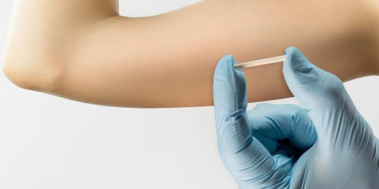 Implantes hormonais exigem cautela em mulheres com lipedema; saiba mais